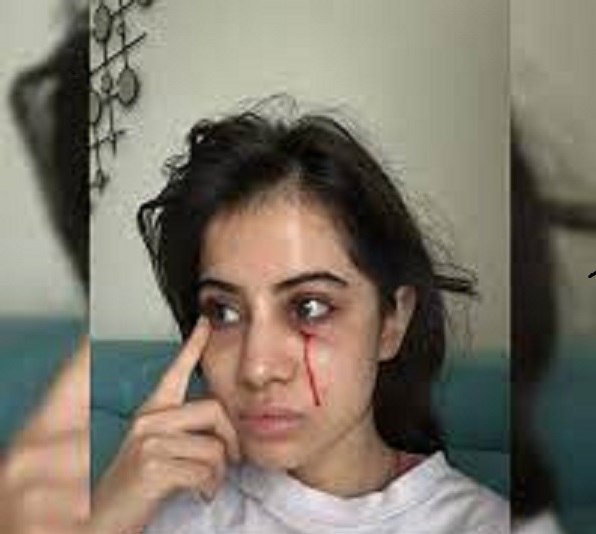 रक्ताने माखलेला चेहरा ! उर्फीवर कोणी केला हल्ला ? चाहते चिंतेत; उर्फीने स्वतः केला खुलासा , म्हणाली...